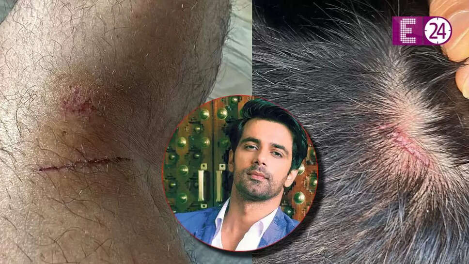 अनुज सचदेवा की पार्किंग विवाद में मारपीट, सोशल मीडिया पर साझा की तस्वीरें