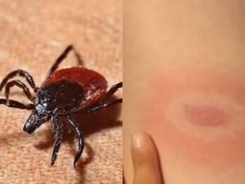 आमतौर पर हम सोचते हैं कि अगर कोई बीमारी है तो वह दवा से ठीक हो जाएगी। लेकिन ब्रिटेन में एक 5 साल के बच्चे को एक दुर्लभ बीमारी है जो धीरे-धीरे उसकी जान ले रही है। आपको जानकर हैरानी होगी कि बच्चे को यह बीमारी उसकी मां से मिली है। और एक छोटे से कीड़े के काटने से माँ। अगर अनुपचारित छोड़ दिया जाए तो दोनों कुछ वर्षों के भीतर मर सकते हैं। लेकिन उनकी जान बचाने की कीमत बहुत अधिक है। करीब एक करोड़। इतना ही नहीं पूरे परिवार को स्कॉटलैंड छोड़कर जर्मनी जाना पड़ता है क्योंकि वहां इलाज की कोई सुविधा नहीं है।  दरअसल, 36 साल की एमिली गिलमोर और उनके 5 साल के बेटे ओलिवर को एक खास तरह का संक्रमण है। इसे लाइम रोग भी कहा जाता है। यह बोरेलिया बर्गडोरफेरी नामक जीवाणु के काटने से होता है। लाइम रोग के लक्षण काटने के 3 से 30 दिन बाद दिखाई देते हैं। इन लक्षणों में बुखार, सिरदर्द, कमजोरी, मांसपेशियों या जोड़ों में दर्द शामिल हैं।  यह बग 23 साल पहले काटा गया था स्कॉटलैंड की रहने वाली एमिली को करीब 23 साल पहले इस कीड़े ने काटा था। उस समय वह पहाड़ी से नीचे आ रही थी। फिर उसने फ्लू के लक्षण विकसित किए। उन्होंने डेली रिकॉर्ड को बताया, "मैं कभी भी पूरी तरह से ठीक नहीं हुई और तब से जोड़ों के दर्द से पीड़ित हूं। यह एक अजीब स्थिति है।" मैं यह सब सहती थी। लेकिन 2020 में बालों का झड़ना शुरू होते ही लक्षण और बिगड़ गए। आंखें धुंधली लगने लगीं। ठंड के मौसम में भी रात को पसीना आने लगा। हालात यह हो गए कि मैं घर से अपनी कार में कहीं जा रहा था और पता नहीं कैसे मैं यहां पहुंच गया।  दिल के साथ-साथ दिमाग में भी घाव एमिली ने डॉक्टर को दिखाया। बाद में उनके दिल के साथ दिमाग में भी घाव पाया गया। जांच में पता चला कि वह लाइम रोग की शिकार थी। उसके बाद बेटे में भी लक्षण दिखने लगे। यह धीरे-धीरे हमें मृत्यु की ओर ले जाता है। बच्चों में इस संक्रमण के कारण भूलने की बीमारी भी हो सकती है। डबलिन के एक डॉक्टर ने कहा कि स्कॉटलैंड में उसका कोई इलाज नहीं है, उसे जर्मनी जाना पड़ा। इस पर कुल 100,000 पाउंड यानी करीब एक करोड़ रुपये खर्च होंगे। उपचार को हाइपरथर्मिया कहा जाता है, जिससे बैक्टीरिया को मारने के लिए शरीर को गर्म किया जाएगा। एमिली ने खुलासा किया कि उसने पिछले चार वर्षों में विभिन्न उपचारों और सहायता पर लगभग 40,000 पाउंड खर्च किए हैं - और केवल पिछले 12 महीनों में &pound; 25,000। अब पैसे नहीं बचे। यदि अनुपचारित छोड़ दिया जाए, तो माँ और बेटा गंभीर रूप से अक्षम हो जाएंगे और धीरे-धीरे मर जाएंगे।