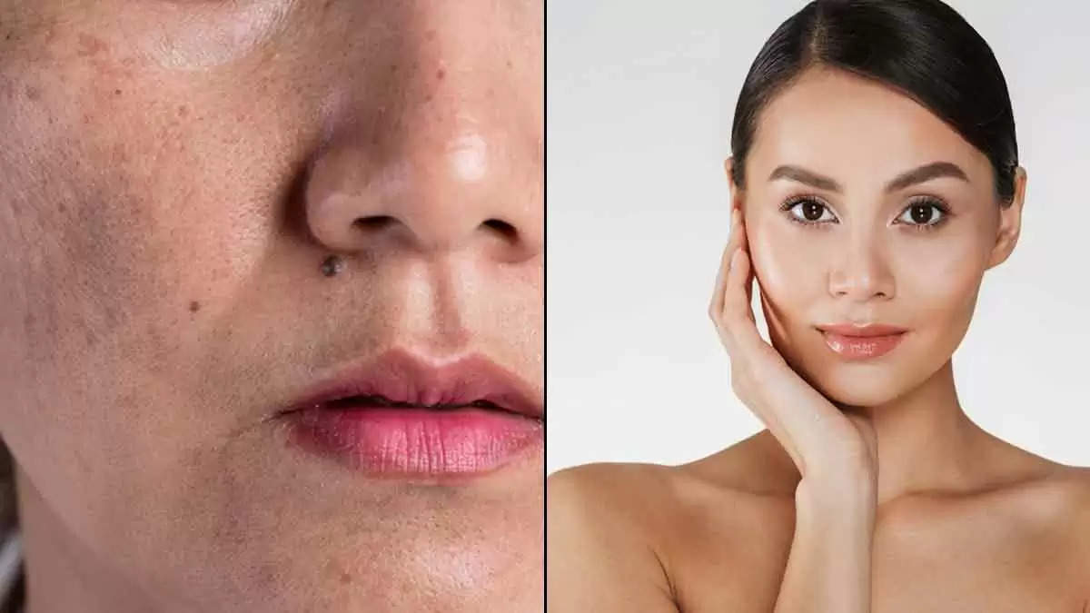 Skin Care Tips-  चेहरे पर हो रहा है Hyperpigmentation, इसे रोकने के लिए जल्दी करें 5 काम