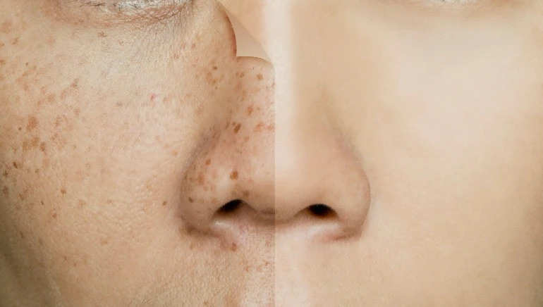 Skin Care Tips-  चेहरे पर हो रहा है Hyperpigmentation, इसे रोकने के लिए जल्दी करें 5 काम