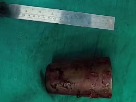 दुनिया में कुछ ऐसे भी अजीबोगरीब लोग हैं, जिनके क्रेज को जानने के बाद यकीन करना मुश्किल है। एक पल के लिए उसकी हरकतें उसे जीवन भर के लिए परेशान कर देती हैं। अब इस मामले को नेपाल से ही देख लीजिए. यहां डॉक्टरों ने एक शख्स के पेट से स्टील का गिलास निकाला। अब आप सोच रहे होंगे कि आखिर इतना गिलास उनके पेट में कैसे चला गया? आपने कई बार पढ़ा होगा कि कैसे कुछ लोग अपनी हवस में शरीर के अंदर कुछ अजीबोगरीब चीजें डाल देते हैं। ऐसा ही मामला है। लेकिन इस बार शख्स ने अपना गुनाह छुपाने के लिए एक अनोखा बहाना निकाला।  इस शादीशुदा शख्स के पेट में स्टील का गिलास था. कहा जा रहा है कि इससे पहले भी उसने अपने प्राइवेट पार्ट के जरिए कुछ चीजें शरीर के अंदर डाल ली थीं। लेकिन हर बार वह सकुशल बाहर निकल आया। लेकिन इस बार ऐसा नहीं हो सका. इस बार गिलास सीधा उसके अंदर चला गया और बाहर नहीं निकला। जब दर्द काबू से बाहर हो गया तो उस व्यक्ति ने डॉक्टर को दिखाने का फैसला किया। तीन दिन बाद उनके पेट से एक गिलास निकाला गया जो 12 सेंटीमीटर का था।   अजब कहानी बनाई इस पूरे मामले को नेशनल मेडिकल एसोसिएशन ऑफ नेपाल ने शेयर किया है. मामले में व्यक्ति की पहचान गुप्त रखी गई है। हालांकि उनकी उम्र 43 साल बताई जा रही है। उस आदमी ने कहा कि वह गलती से गिलास के ऊपर बैठ गया। जिससे स्टील का शीशा अंदर तक घुस गया। हालांकि, बाद में उसने स्वीकार किया कि नशे में रहते हुए उसने यौन संतुष्टि के लिए ऐसा किया था। सन ने मेडिकल एक्सपर्ट्स को बताया कि शीशे की वजह से वह बाथरूम नहीं जा सकते थे. हां, उसे गैस पास करने में कोई दिक्कत नहीं हुई।  अभी बाहर आया शख्स ने पहले तो खुद ही शीशा हटाने की कोशिश की। लेकिन जब इसमें सफलता नहीं मिली तो वह डॉक्टर के पास गए। डॉक्टरों द्वारा अपनाए जाने वाले तरीके को मेडिकल की भाषा में मिल्किंग कहा जाता है। यह निचली आंत को संकुचित करता है। लेकिन इस तरह गिलास नहीं निकला। इसके बाद सर्जरी कर शीशा हटा दिया गया। सर्जरी के पांचवें दिन व्यक्ति को रिफ्रेश किया गया और सातवें दिन उसे दिया गया। बात दो महीने पहले की है लेकिन अब इसे शेयर किया गया है।